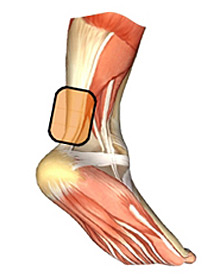 Achilles Tendonitis Injury