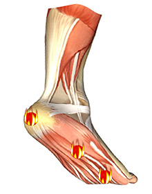 Injury Expert - blisters