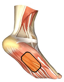 Injury Expert - Plantar Fascia